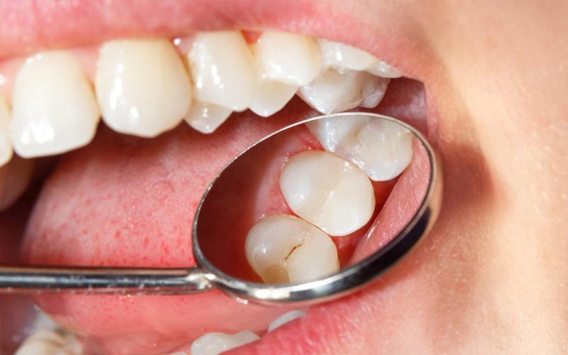 dental services, fillings, general dentistry